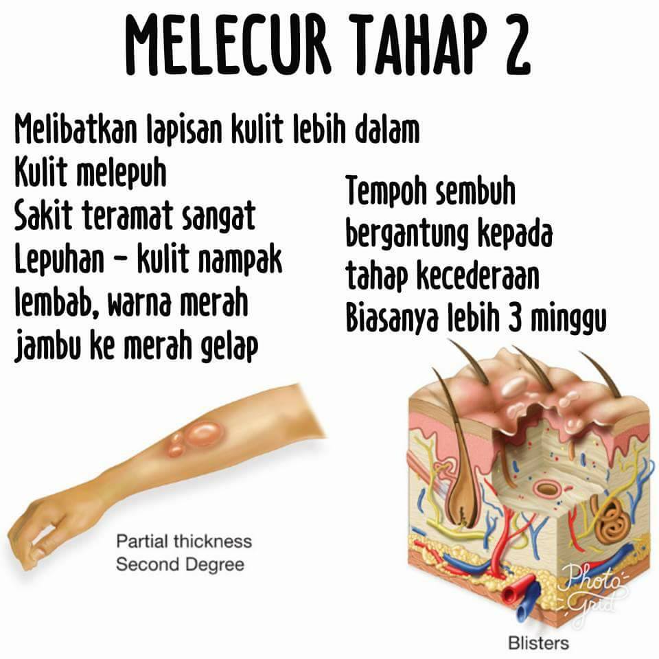Petua Tabur Tepung Bila Anak Melecur? Jangan Buat Dulu 